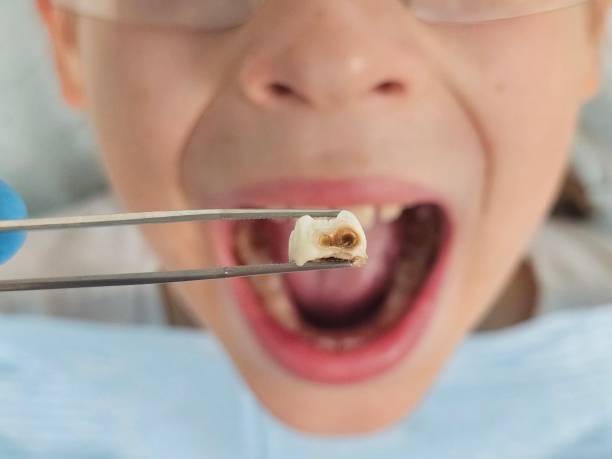 Best Chipped Tooth Repair Near Me  in Amityville, NY